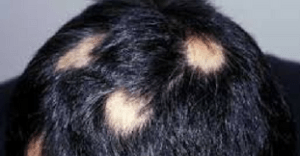 "alopecia homeopathy treatment"