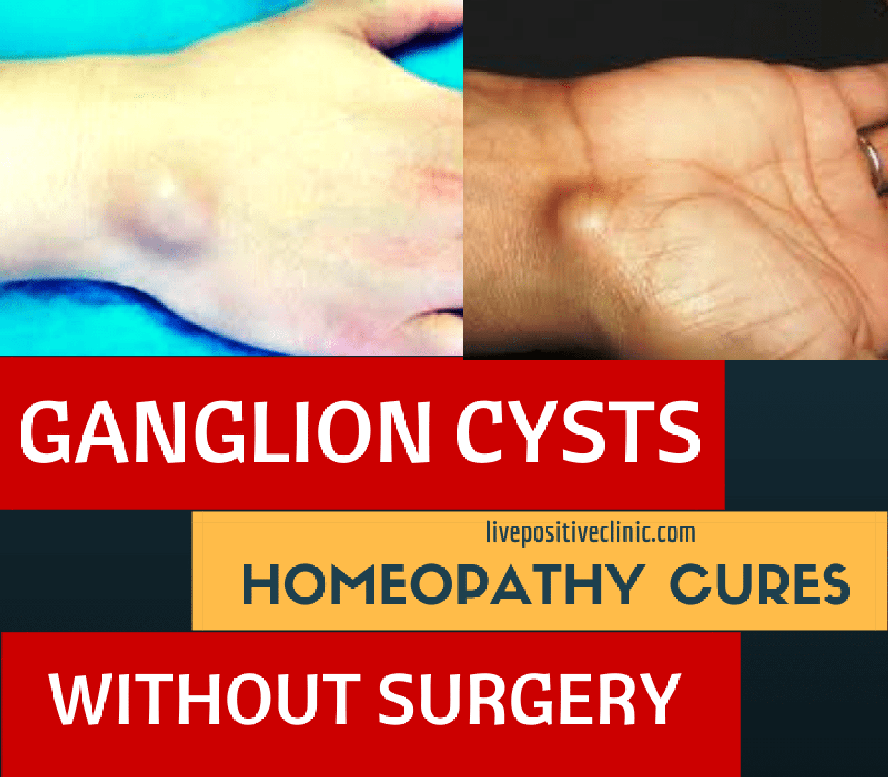 Cyst cure for ganglion Home Remedies