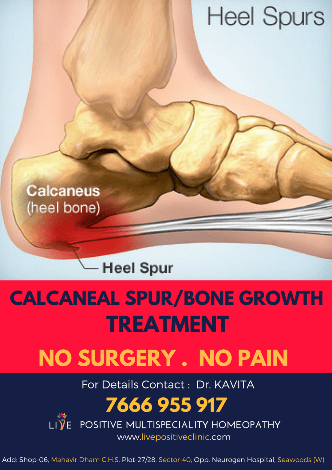 Bone spur - Homeopathy Treatment and Homeopathic Remedies - Doctor Bhatia