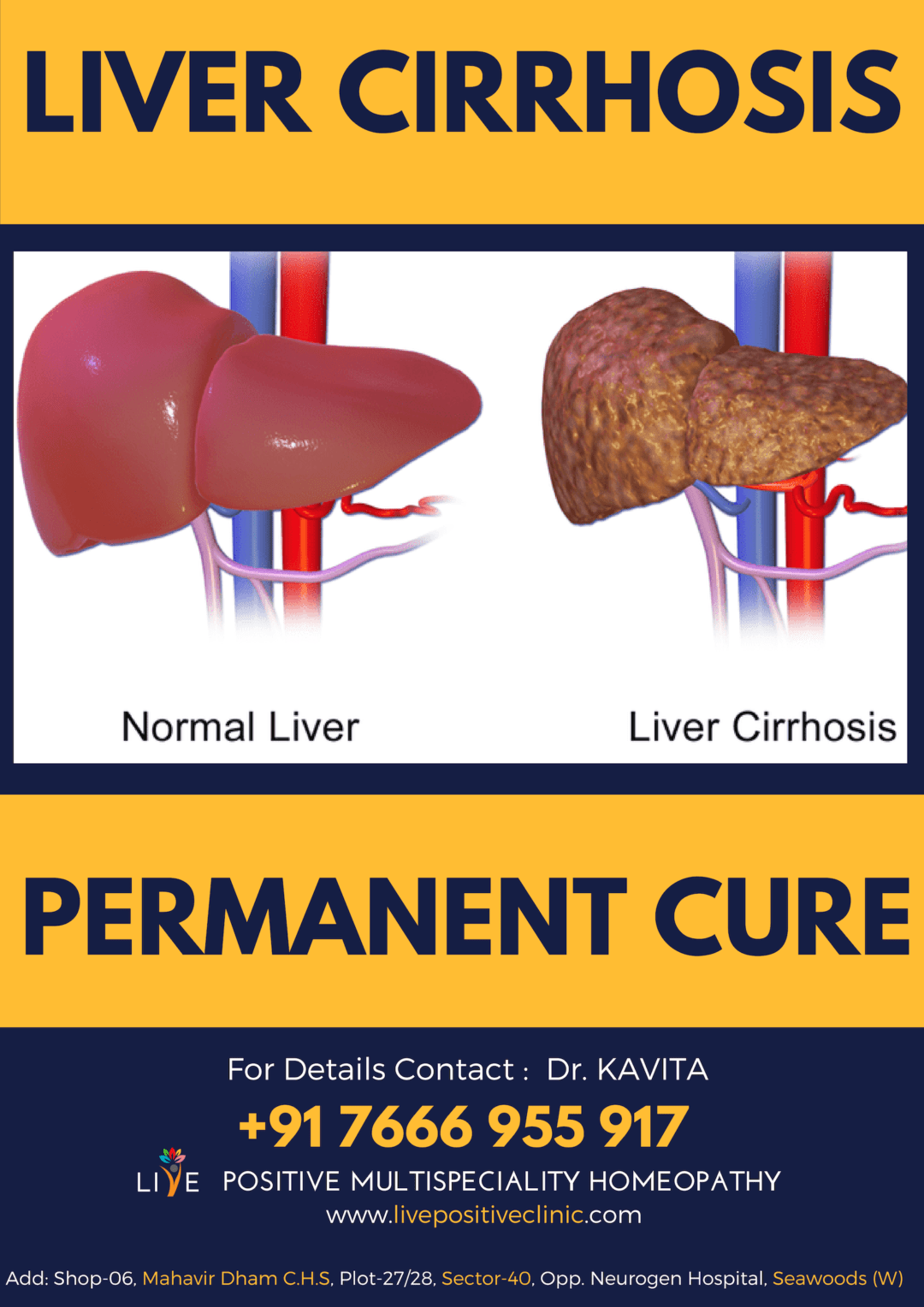 Liver Cirrhosis Treatment In Homeopathycirrhosis Cure Live Positive Multispeciality Homeopathy